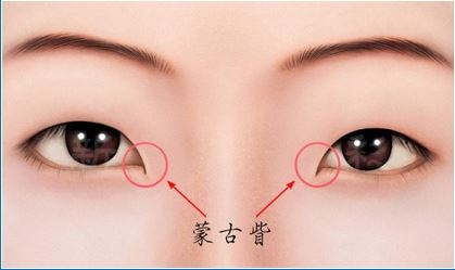 蒙古眥開眼頭雙眼皮手術