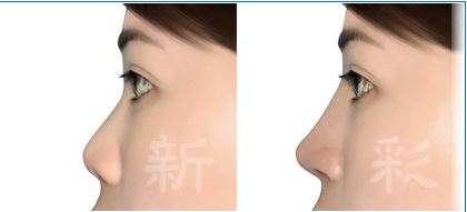 韓式隆鼻/開放式鼻整形